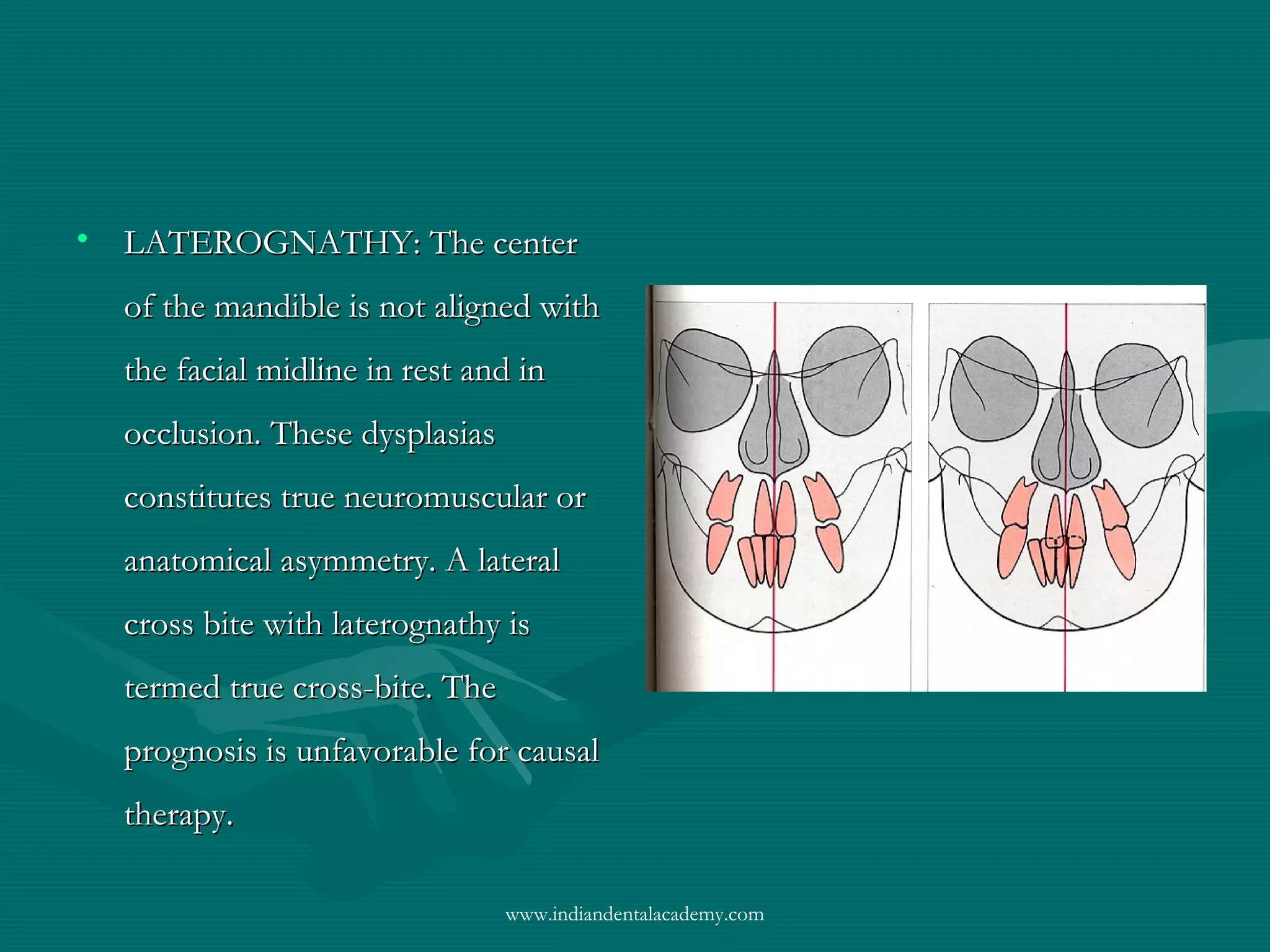 • LATEROGNATHY: The centerLATEROGNATHY: The center
of the mandible is not aligned withof the mandible is not aligned with
the facial midline in rest and inthe facial midline in rest and in
occlusion. These dysplasiasocclusion. These dysplasias
constitutes true neuromuscular orconstitutes true neuromuscular or
anatomical asymmetry. A lateralanatomical asymmetry. A lateral
cross bite with laterognathy iscross bite with laterognathy is
termed true cross-bite. Thetermed true cross-bite. The
prognosis is unfavorable for causalprognosis is unfavorable for causal
therapy.therapy.
www.indiandentalacademy.com
 
