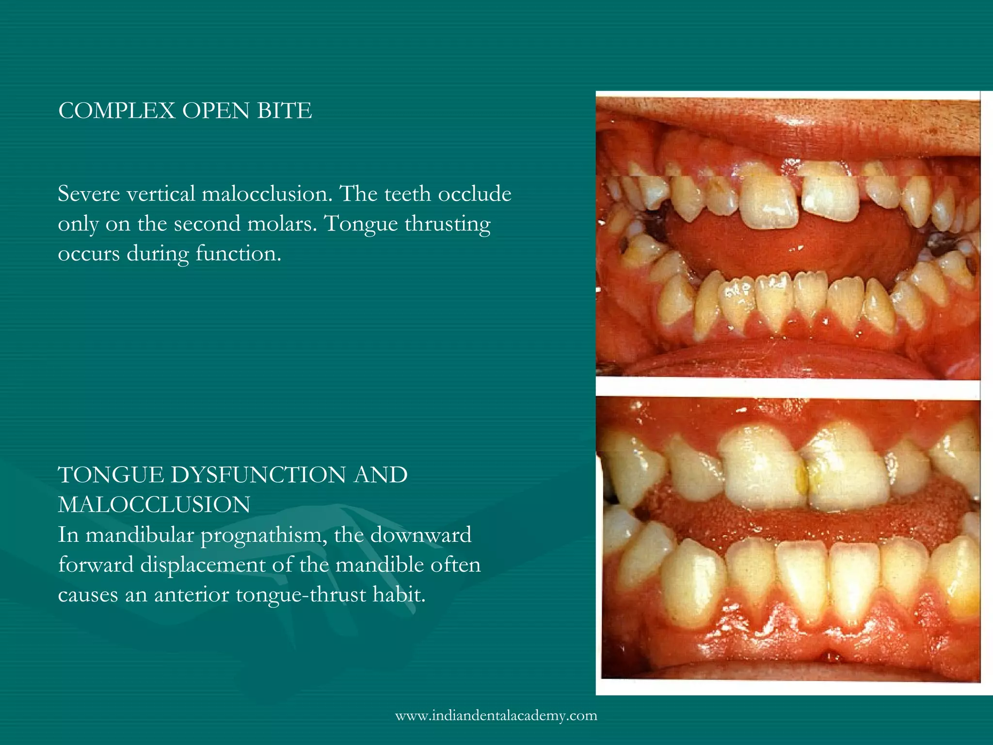 COMPLEX OPEN BITE
Severe vertical malocclusion. The teeth occlude
only on the second molars. Tongue thrusting
occurs during function.
TONGUE DYSFUNCTION AND
MALOCCLUSION
In mandibular prognathism, the downward
forward displacement of the mandible often
causes an anterior tongue-thrust habit.
www.indiandentalacademy.com
 