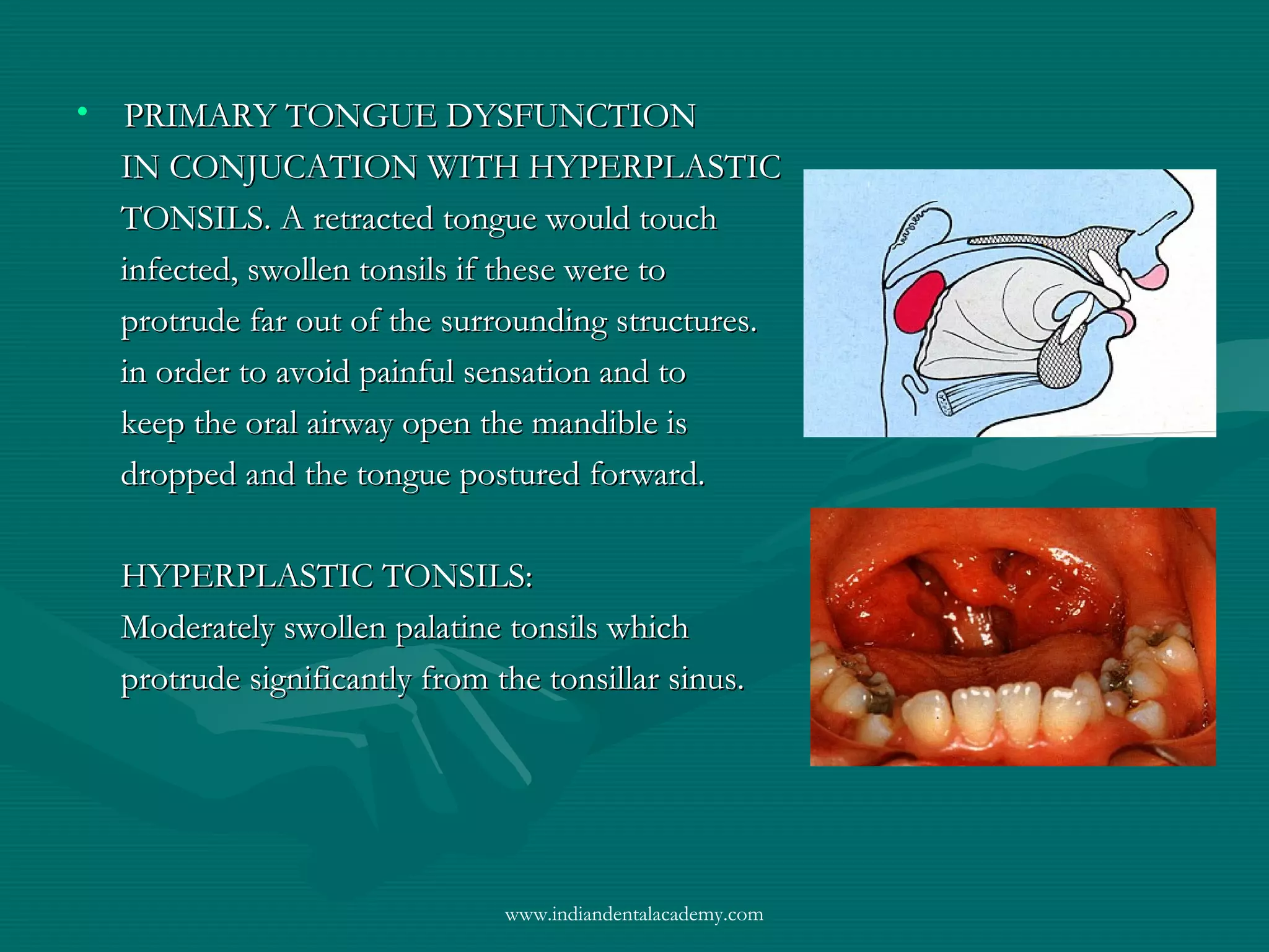 • PRIMARY TONGUE DYSFUNCTIONPRIMARY TONGUE DYSFUNCTION
IN CONJUCATION WITH HYPERPLASTICIN CONJUCATION WITH HYPERPLASTIC
TONSILS. A retracted tongue would touchTONSILS. A retracted tongue would touch
infected, swollen tonsils if these were toinfected, swollen tonsils if these were to
protrude far out of the surrounding structures.protrude far out of the surrounding structures.
in order to avoid painful sensation and toin order to avoid painful sensation and to
keep the oral airway open the mandible iskeep the oral airway open the mandible is
dropped and the tongue postured forward.dropped and the tongue postured forward.
HYPERPLASTIC TONSILS:HYPERPLASTIC TONSILS:
Moderately swollen palatine tonsils whichModerately swollen palatine tonsils which
protrude significantly from the tonsillar sinus.protrude significantly from the tonsillar sinus.
www.indiandentalacademy.com
 