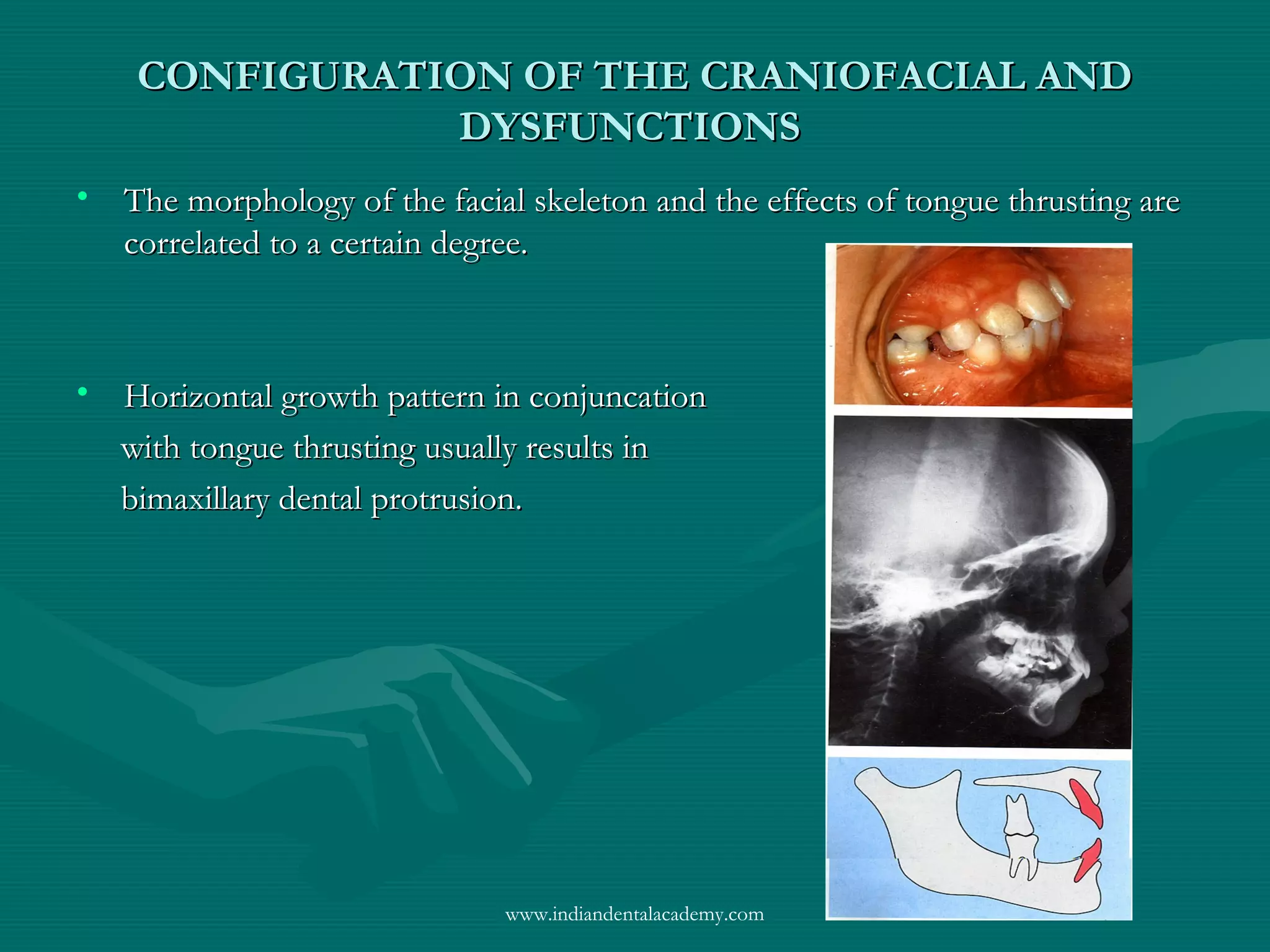 CONFIGURATION OF THE CRANIOFACIAL ANDCONFIGURATION OF THE CRANIOFACIAL AND
DYSFUNCTIONSDYSFUNCTIONS
• The morphology of the facial skeleton and the effects of tongue thrusting areThe morphology of the facial skeleton and the effects of tongue thrusting are
correlated to a certain degree.correlated to a certain degree.
• Horizontal growth pattern in conjuncationHorizontal growth pattern in conjuncation
with tongue thrusting usually results inwith tongue thrusting usually results in
bimaxillary dental protrusion.bimaxillary dental protrusion.
www.indiandentalacademy.com
 