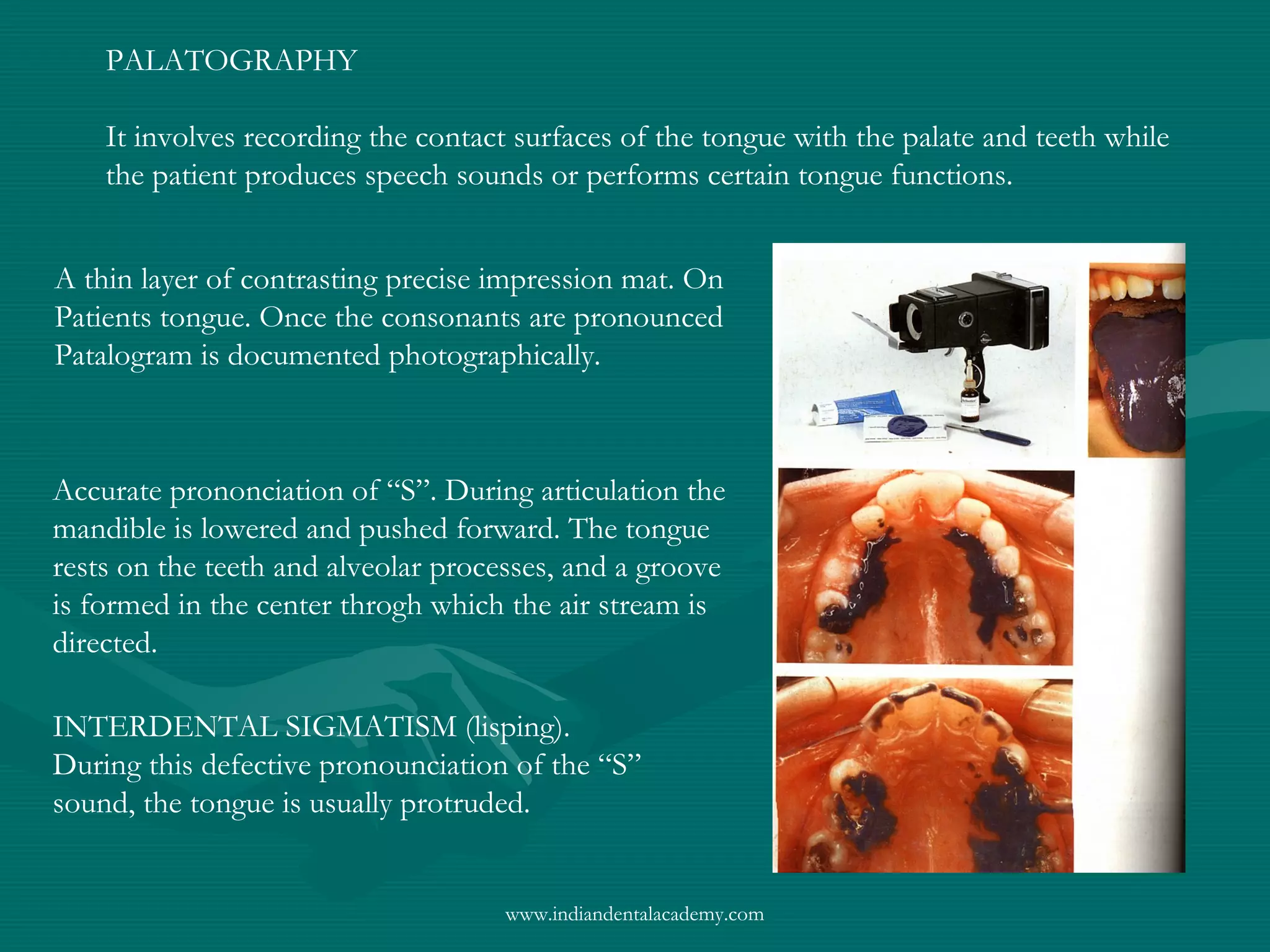 PALATOGRAPHY
It involves recording the contact surfaces of the tongue with the palate and teeth while
the patient produces speech sounds or performs certain tongue functions.
A thin layer of contrasting precise impression mat. On
Patients tongue. Once the consonants are pronounced
Patalogram is documented photographically.
Accurate prononciation of “S”. During articulation the
mandible is lowered and pushed forward. The tongue
rests on the teeth and alveolar processes, and a groove
is formed in the center throgh which the air stream is
directed.
INTERDENTAL SIGMATISM (lisping).
During this defective pronounciation of the “S”
sound, the tongue is usually protruded.
www.indiandentalacademy.com
 