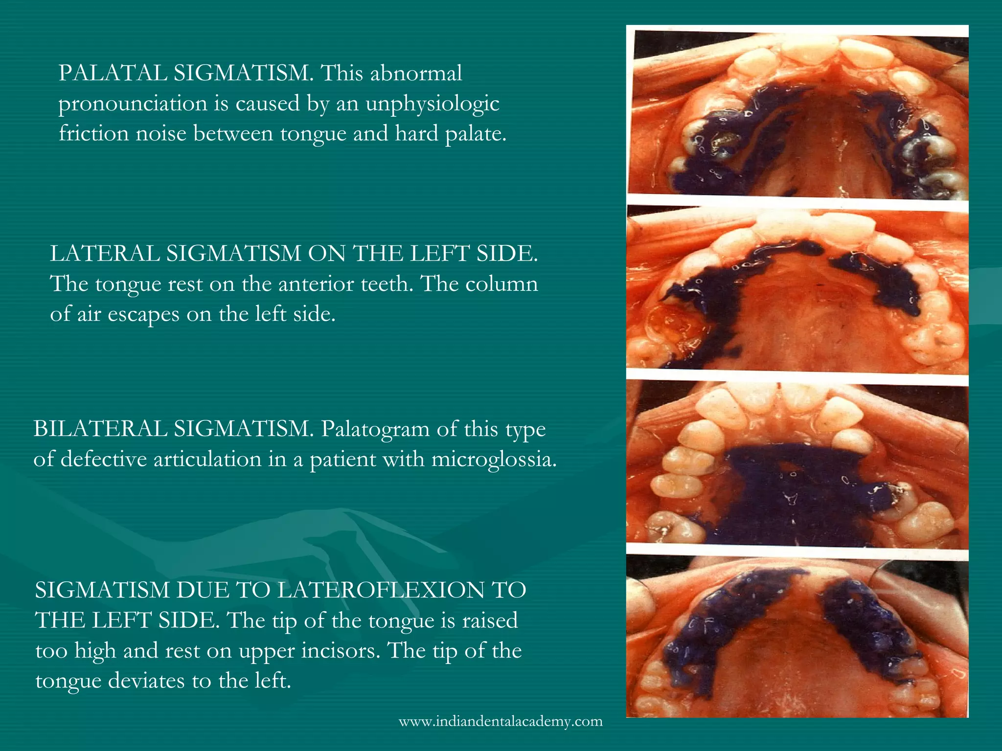 PALATAL SIGMATISM. This abnormal
pronounciation is caused by an unphysiologic
friction noise between tongue and hard palate.
LATERAL SIGMATISM ON THE LEFT SIDE.
The tongue rest on the anterior teeth. The column
of air escapes on the left side.
BILATERAL SIGMATISM. Palatogram of this type
of defective articulation in a patient with microglossia.
SIGMATISM DUE TO LATEROFLEXION TO
THE LEFT SIDE. The tip of the tongue is raised
too high and rest on upper incisors. The tip of the
tongue deviates to the left.
www.indiandentalacademy.com
 