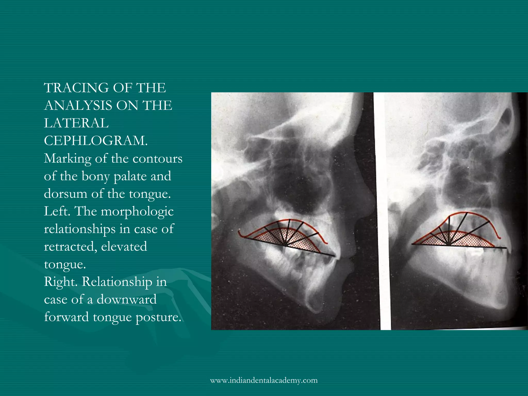 TRACING OF THE
ANALYSIS ON THE
LATERAL
CEPHLOGRAM.
Marking of the contours
of the bony palate and
dorsum of the tongue.
Left. The morphologic
relationships in case of
retracted, elevated
tongue.
Right. Relationship in
case of a downward
forward tongue posture.
www.indiandentalacademy.com
 