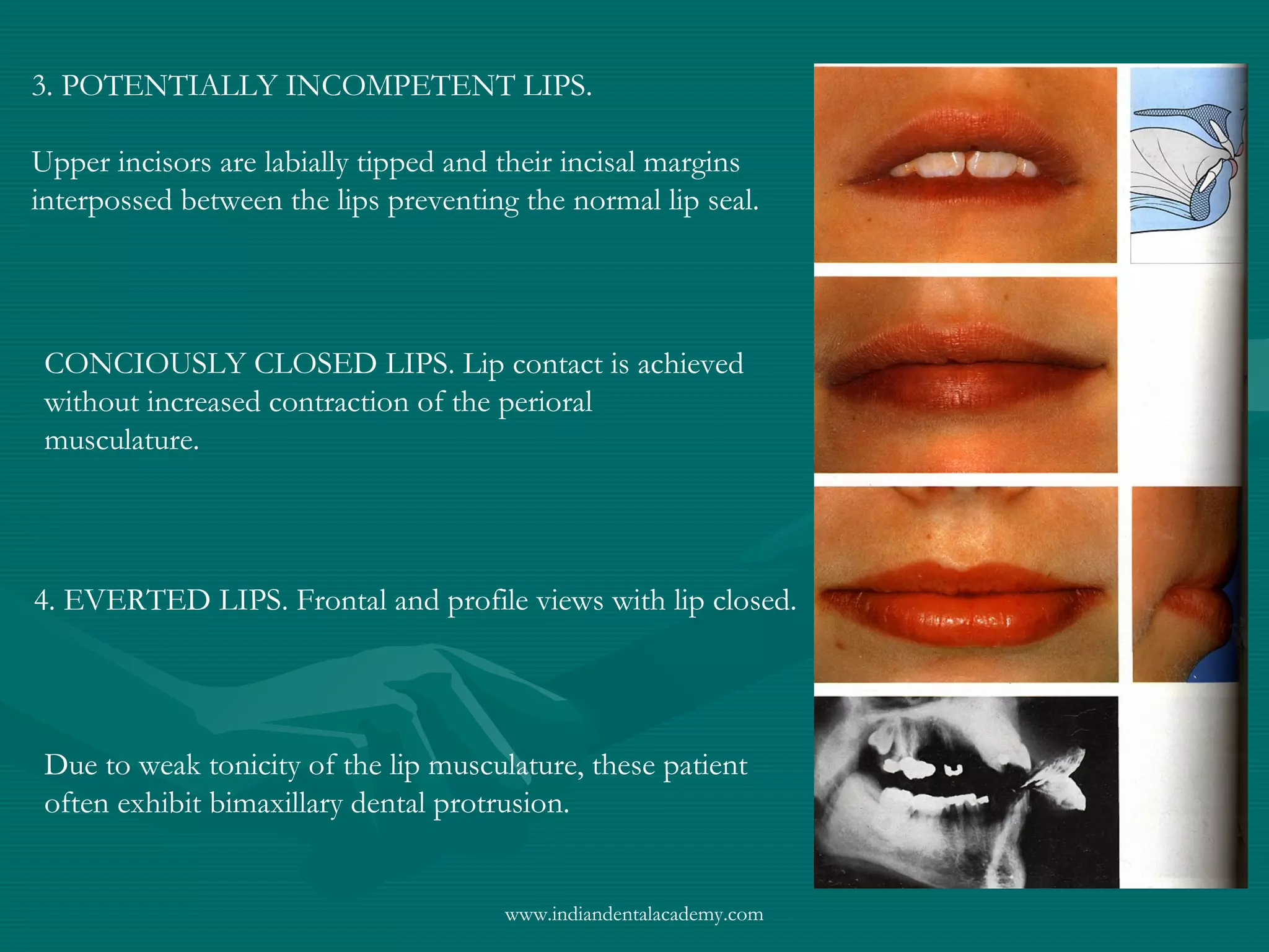 3. POTENTIALLY INCOMPETENT LIPS.
Upper incisors are labially tipped and their incisal margins
interpossed between the lips preventing the normal lip seal.
CONCIOUSLY CLOSED LIPS. Lip contact is achieved
without increased contraction of the perioral
musculature.
4. EVERTED LIPS. Frontal and profile views with lip closed.
Due to weak tonicity of the lip musculature, these patient
often exhibit bimaxillary dental protrusion.
www.indiandentalacademy.com
 
