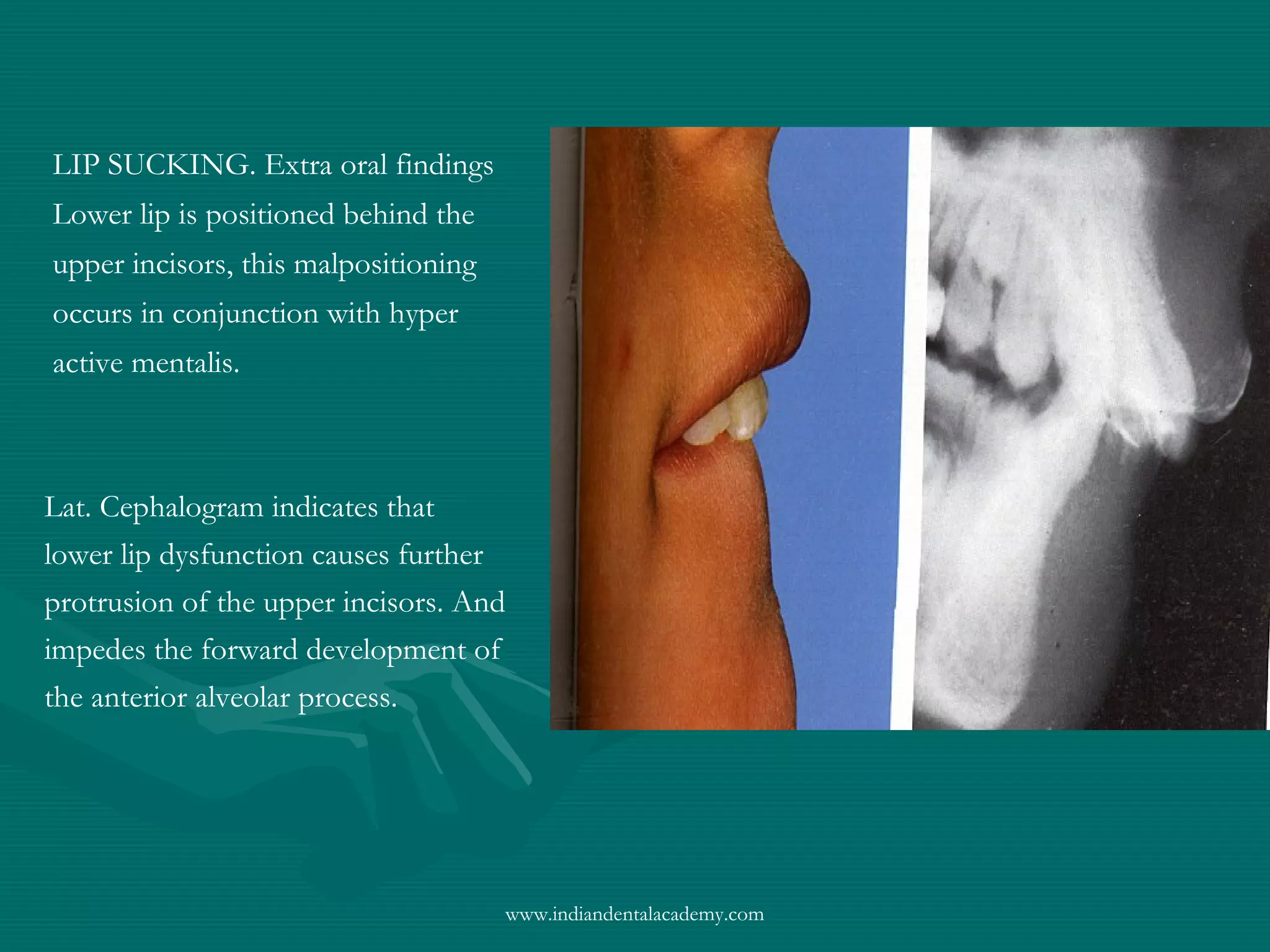 LIP SUCKING. Extra oral findings
Lower lip is positioned behind the
upper incisors, this malpositioning
occurs in conjunction with hyper
active mentalis.
Lat. Cephalogram indicates that
lower lip dysfunction causes further
protrusion of the upper incisors. And
impedes the forward development of
the anterior alveolar process.
www.indiandentalacademy.com
 