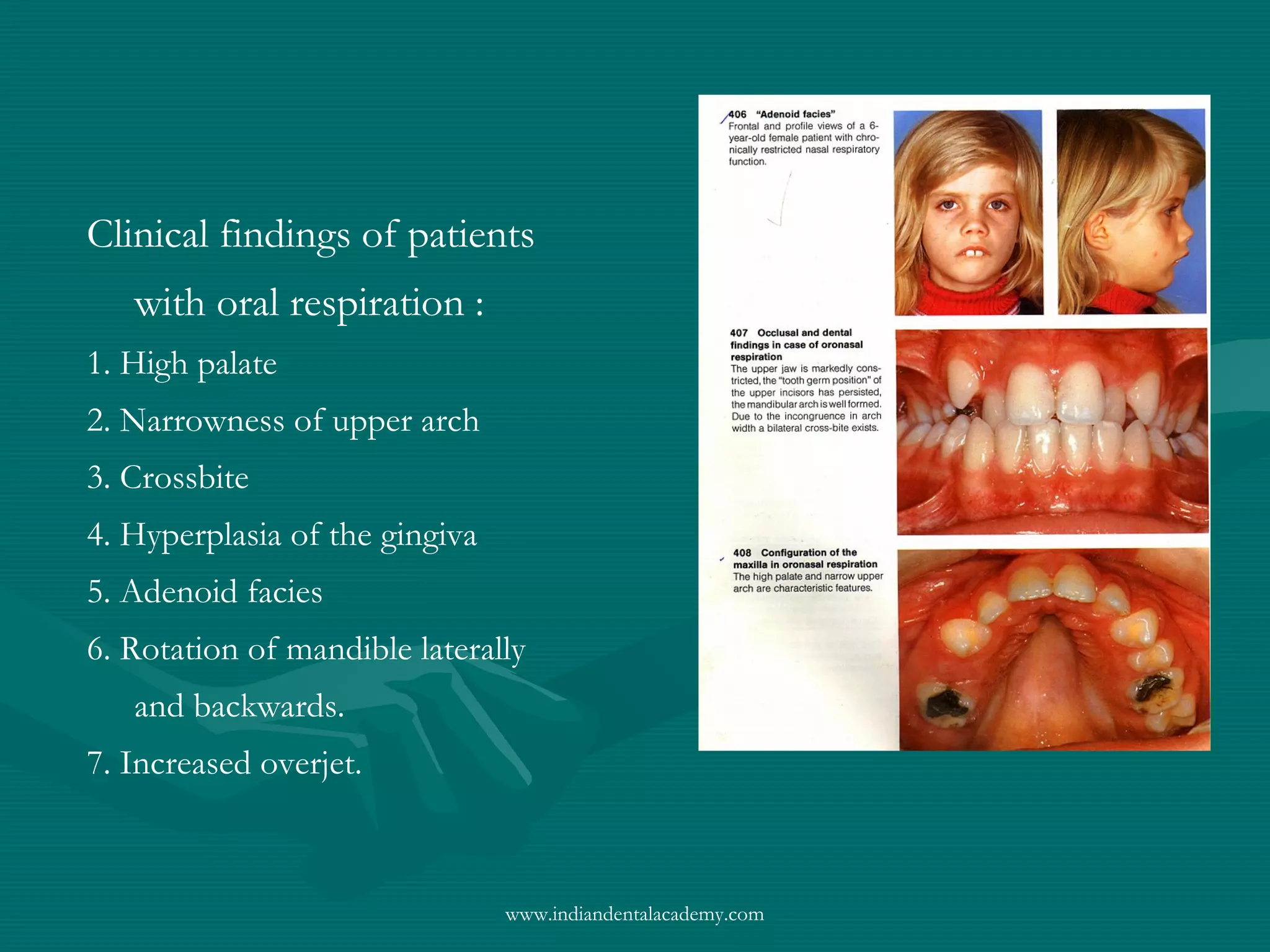 Clinical findings of patients
with oral respiration :
1. High palate
2. Narrowness of upper arch
3. Crossbite
4. Hyperplasia of the gingiva
5. Adenoid facies
6. Rotation of mandible laterally
and backwards.
7. Increased overjet.
www.indiandentalacademy.com
 