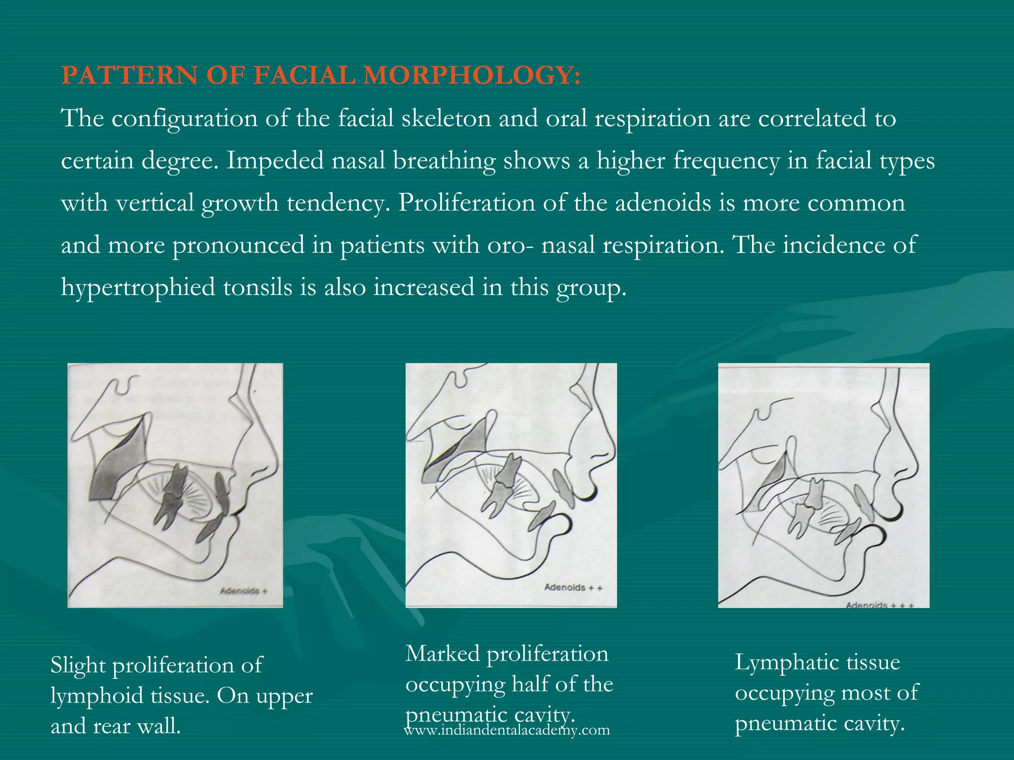 PATTERN OF FACIAL MORPHOLOGY:
The configuration of the facial skeleton and oral respiration are correlated to
certain degree. Impeded nasal breathing shows a higher frequency in facial types
with vertical growth tendency. Proliferation of the adenoids is more common
and more pronounced in patients with oro- nasal respiration. The incidence of
hypertrophied tonsils is also increased in this group.
Slight proliferation of
lymphoid tissue. On upper
and rear wall.
Marked proliferation
occupying half of the
pneumatic cavity.
Lymphatic tissue
occupying most of
pneumatic cavity.www.indiandentalacademy.com
 