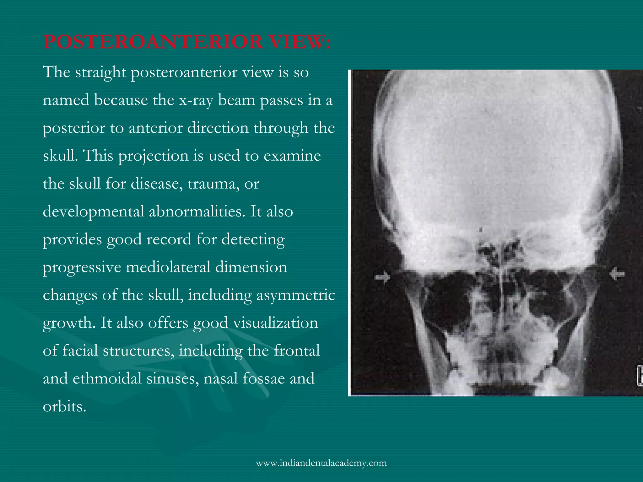 POSTEROANTERIOR VIEW:
The straight posteroanterior view is so
named because the x-ray beam passes in a
posterior to anterior direction through the
skull. This projection is used to examine
the skull for disease, trauma, or
developmental abnormalities. It also
provides good record for detecting
progressive mediolateral dimension
changes of the skull, including asymmetric
growth. It also offers good visualization
of facial structures, including the frontal
and ethmoidal sinuses, nasal fossae and
orbits.
www.indiandentalacademy.com
 