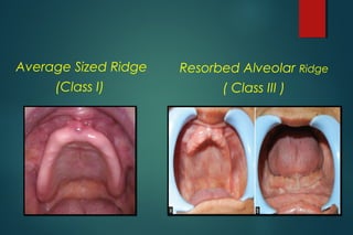 Diagnosis for edentulous patients | PPT