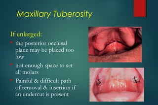 Diagnosis for edentulous patients | PPT