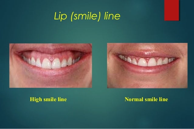 edentulous patients