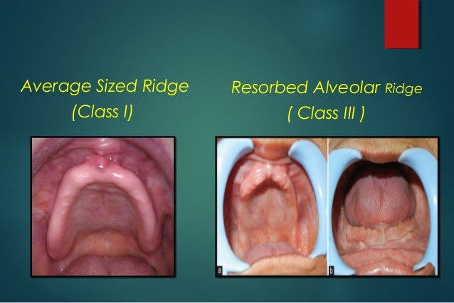 classification of edentulous ridge