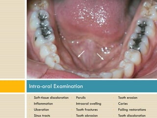 Intra-oral Examination
•

Soft-tissue discoloration

•

Parulis

•

Tooth erosion

•

Inflammation

•

Intraoral swelling

•

Caries

•

Ulceration

•

Tooth fractures

•

Failing restorations

•

Sinus tracts

•

Tooth abrasion

•

Tooth discoloration

 