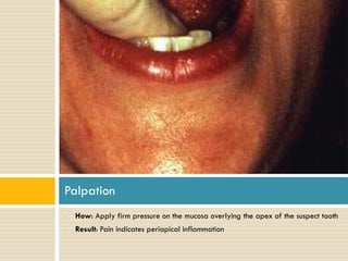 Palpation
•

How: Apply firm pressure on the mucosa overlying the apex of the suspect tooth

•

Result: Pain indicates periapical inflammation

 