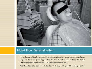 Blood Flow Determination
•

•

How: Sensors (dual wavelength spectrophotometer, pulse oximeter, or laser
Doppler flowmeter) are applied to the facial and lingual surfaces to detect
oxyhemoglobin levels in blood or pulsations in the pulp
Result: Adequate perfusion indicates vital pulp with good healing potential

 