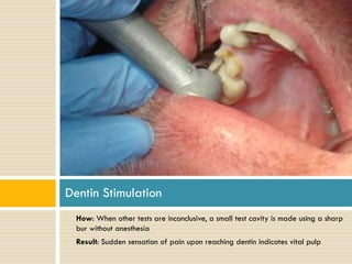 Dentin Stimulation
•

•

How: When other tests are inconclusive, a small test cavity is made using a sharp
bur without anesthesia
Result: Sudden sensation of pain upon reaching dentin indicates vital pulp

 