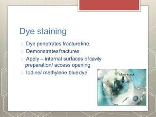 Dye staining
Dye penetrates fractureline
Demonstratesfractures
Apply – internal surfaces ofcavity
preparation/ access opening
Iodine/ methylene bluedye
 