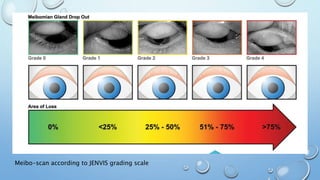 Jenvis Report.pdf Diagnosis & management of dry eye | PPTX