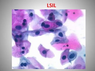 Diagnosis of carcinoma cervix | PPTX