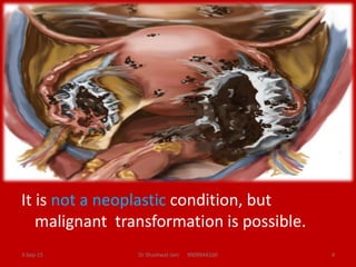 It is not a neoplastic condition, but
malignant transformation is possible.
3-Sep-15 Dr Shashwat Jani 9909944160 4
 