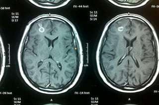 AXIS 3: INVESTIGATIONS
NEUROIMAGING
57
A) MRI
• Diffuse cerebral
pathologies e.g.
cytoarchitectural lesions,
such as neuro...