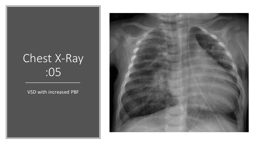 Diagnosis of heart diseases from chest x ray