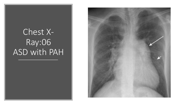 Diagnosis Of Heart Diseases From Chest X Ray