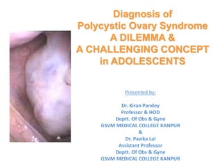 Diagnosis of
Polycystic Ovary Syndrome
A DILEMMA &
A CHALLENGING CONCEPT
in ADOLESCENTS
Presented by:
Dr. Kiran Pandey
Professor & HOD
Deptt. Of Obs & Gyne
GSVM MEDICAL COLLEGE KANPUR
&
Dr. Pavika Lal
Assistant Professor
Deptt. Of Obs & Gyne
GSVM MEDICAL COLLEGE KANPUR
 
