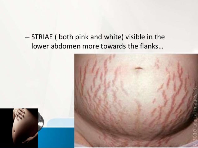 anal and vaginal skin tags during pregnancy anal and vaginal skin tags during pregnancy