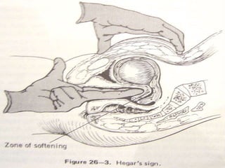 Hegar’s sign
 
