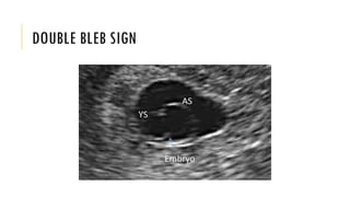 Diagnosis of pregnancy trimester wise.pptx