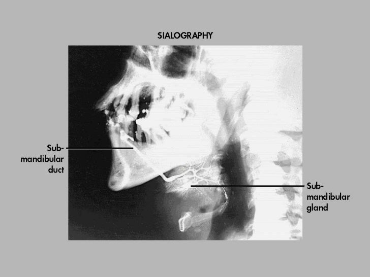 Diagnosis of salivary stones
