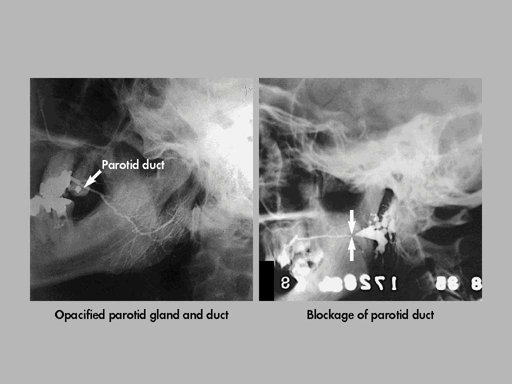 Diagnosis of salivary stones