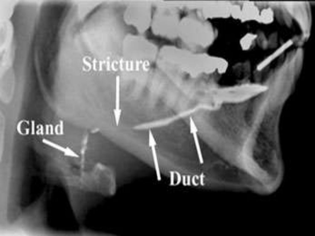 Diagnosis of salivary stones