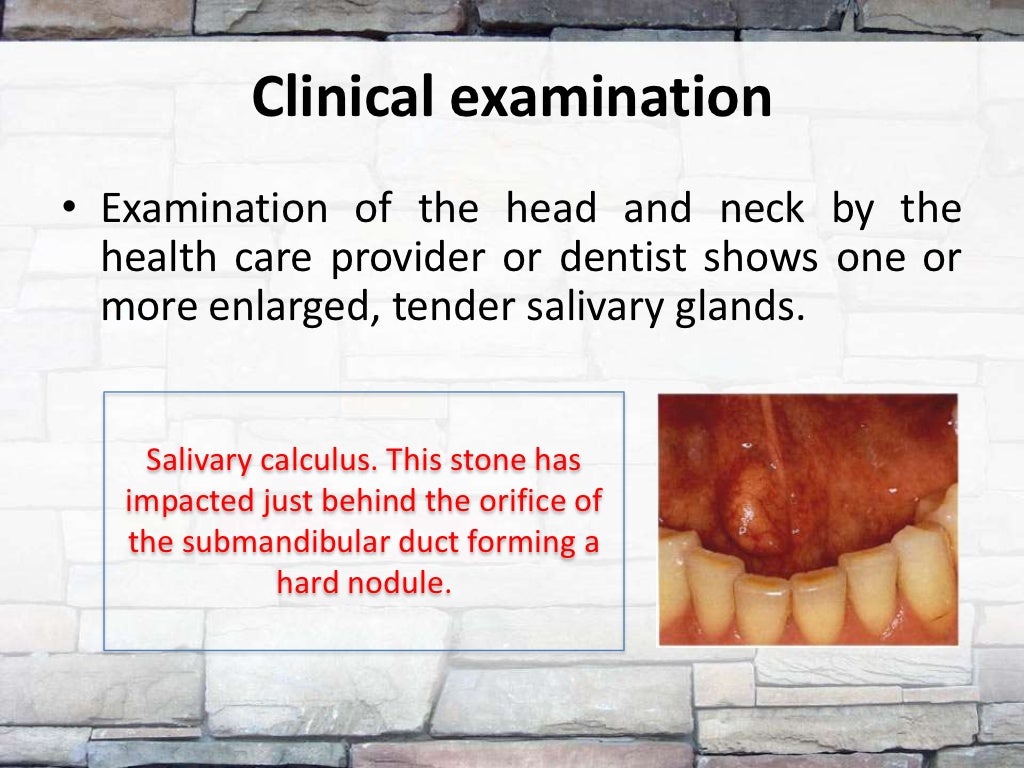 Diagnosis of salivary stones