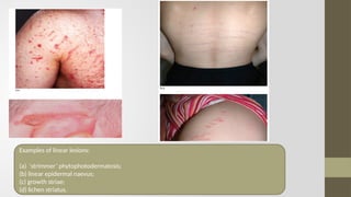 Linear Vesicles diagnosis of skin diseases description.pptx