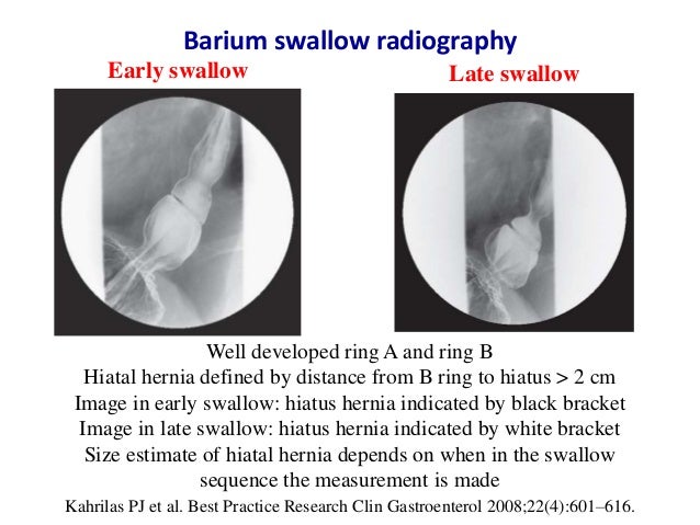 Hiatal hernia diagnosis