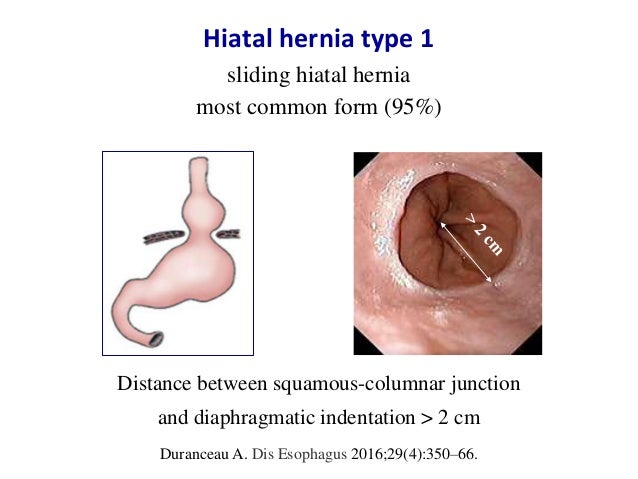 Hiatal hernia diagnosis