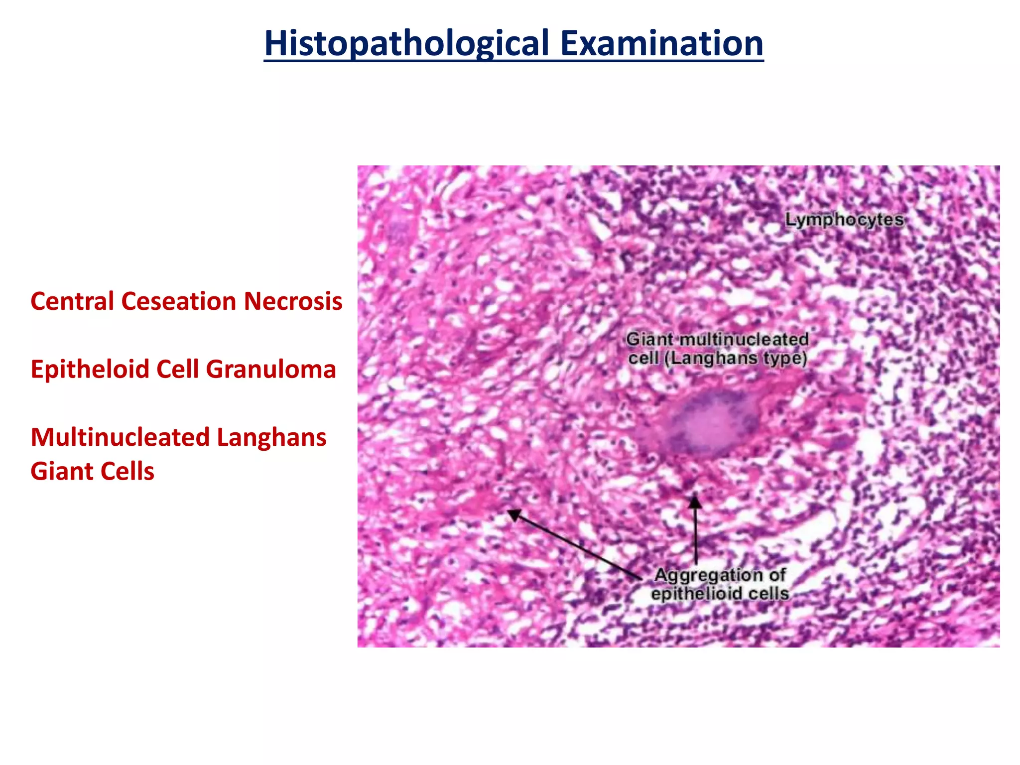 Diagnosis of tuberculosis pptx