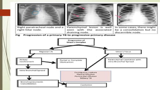 diagnosis of tb in children-approach and evaluation | PPTX
