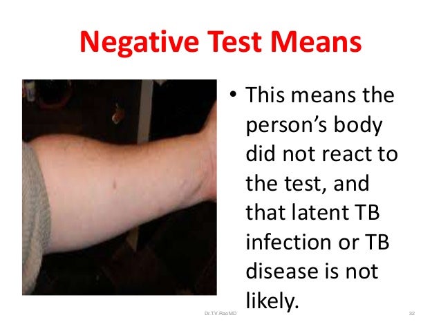 Diagnosis Of Tuberculosis An Update diagnosis-of-tuberculosis-an-update