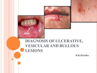 DIAGNOSIS OF ULCERATIVE,
VESICULAR AND BULLOUS
LESIONS
R.K.Haritha
 
