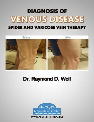 DIAGNOSIS OF
SPIDER AND VARICOSE VEIN THERAPY
Dr. Raymond D. Wolf
 