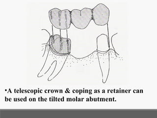 Ast Coping Tooth Diagnosis related to fixed prosthodontics | PPT