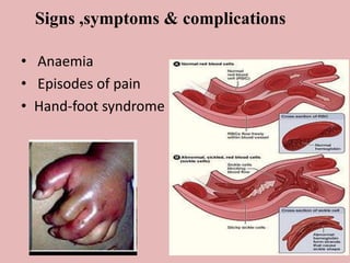 Signs ,symptoms & complications
• Anaemia
• Episodes of pain
• Hand-foot syndrome
 