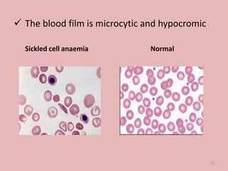  The blood film is microcytic and hypocromic
Sickled cell anaemia Normal
15
 