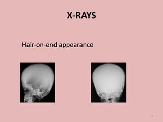 Hair‐on‐end appearance
X-RAYS
23
 