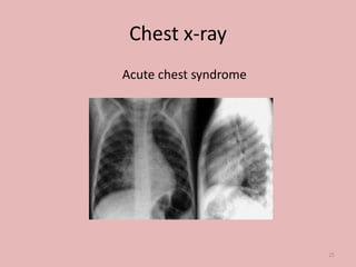 Chest x-ray
Acute chest syndrome
25
 