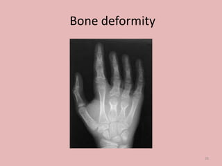 Bone deformity
26
 