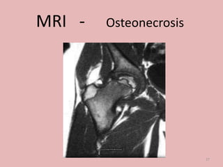 MRI - Osteonecrosis
27
 